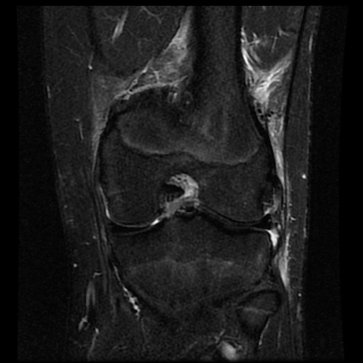 File:Anterior cruciate ligament tear (Radiopaedia 61500-69462 Coronal STIR 13).jpg
