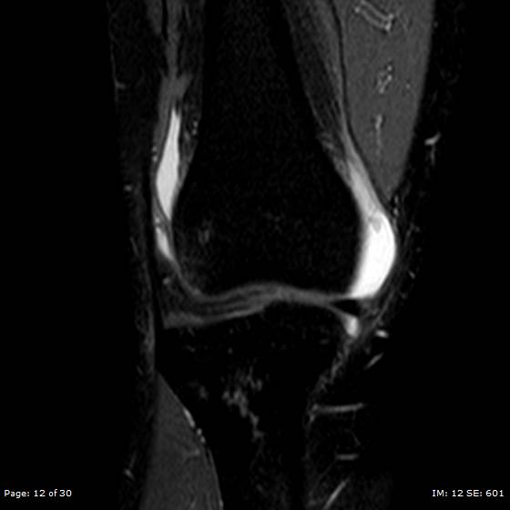 File:Anterior cruciate ligament tear (Radiopaedia 70783-80964 Coronal STIR 12).jpg