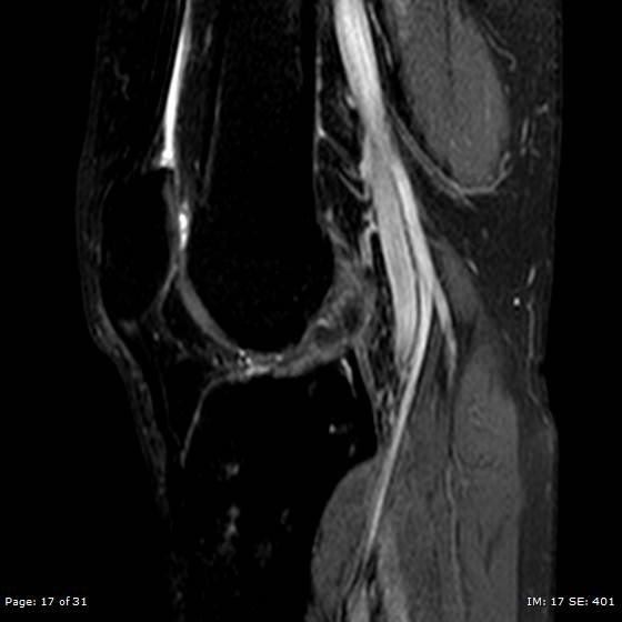 File:Anterior cruciate ligament tear (Radiopaedia 70783-80964 Sagittal STIR 17).jpg