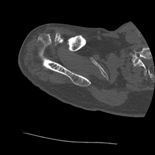 Anterior glenohumeral dislocation with Hill-Sachs lesion (Radiopaedia 62877-71249 Axial bone window 16).jpg