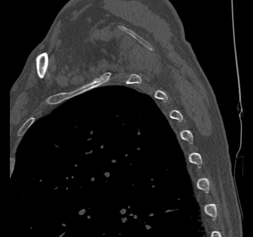 Anterior glenohumeral dislocation with Hill-Sachs lesion (Radiopaedia 62877-71249 Sagittal bone window 60).jpg