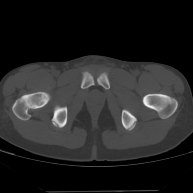 Anterior inferior iliac spine avulsion fracture (Radiopaedia 49469-54627 Axial bone window 50).jpg