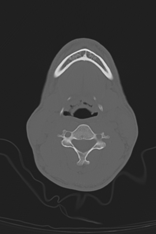 Anterior nasal spine fracture (Radiopaedia 46138-50494 Axial bone window 77).png