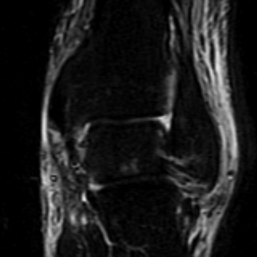 File:Anterior talofibular ligament rupture (Radiopaedia 15831-15484 Coronal STIR 14).jpg