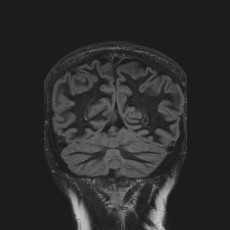 Anterior temporal encephalocele (Radiopaedia 82624-96808 Coronal FLAIR 41).jpg
