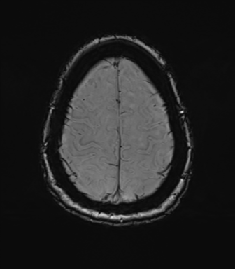 Anterior temporal pole cysts (Radiopaedia 46629-51102 Axial SWI 73).png