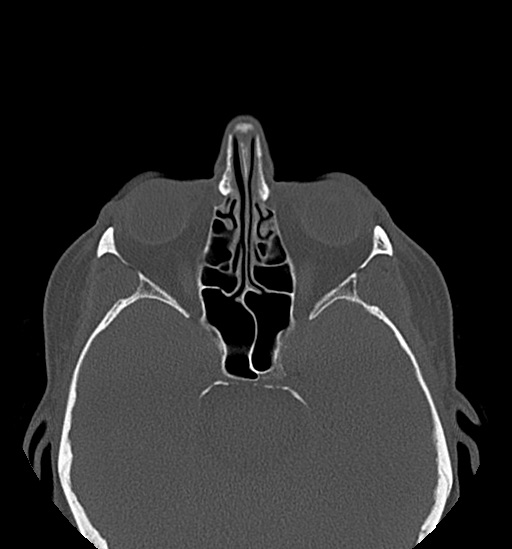 File:Anterior temporomandibular joint dislocation (Radiopaedia 59430-66784 Axial non-contrast 4).jpg