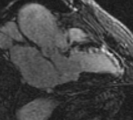 File:Anteroseptal hypokinesia after myocardial infarction (Radiopaedia 15978-15633 H 1).jpg