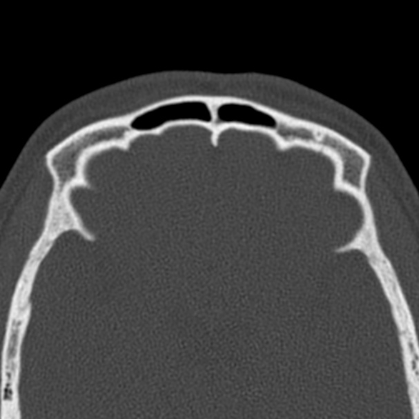 Antrochoanal polyp (Radiopaedia 33984-35202 Axial bone window 71).jpg