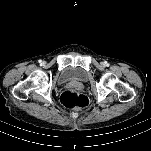File:Aortic aneurysm and Lemmel syndrome (Radiopaedia 86499-102554 A 79).jpg