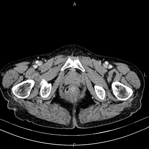 File:Aortic aneurysm and Lemmel syndrome (Radiopaedia 86499-102554 A 83).jpg