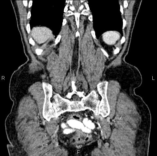 Aortic aneurysm and Lemmel syndrome (Radiopaedia 86499-102554 C 56).jpg