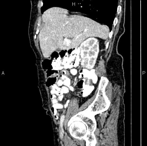 File:Aortic aneurysm and Lemmel syndrome (Radiopaedia 86499-102554 D 22).jpg
