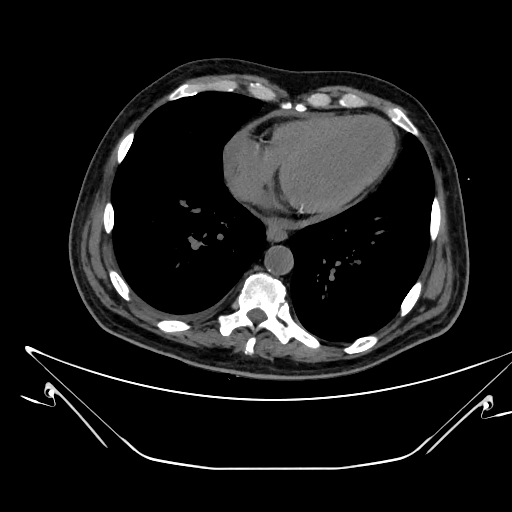 File:Aortic arch aneurysm (Radiopaedia 84109-99365 Axial non-contrast 193).jpg