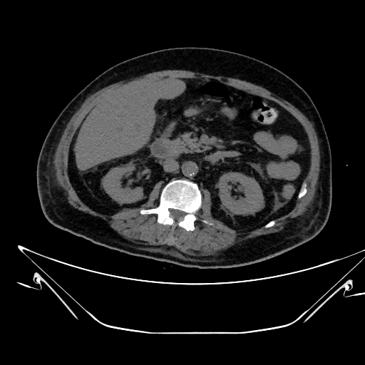 Aortic arch aneurysm (Radiopaedia 84109-99365 Axial non-contrast 341).jpg