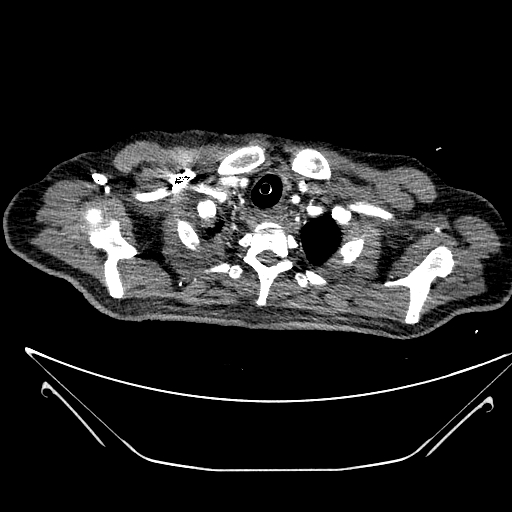 Aortic arch aneurysm (Radiopaedia 84109-99365 B 73).jpg
