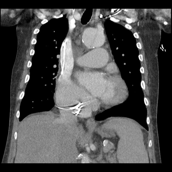 Aortic arch graft infection (FDG PET-CT) (Radiopaedia 71975-82437 Coronal 30).jpg