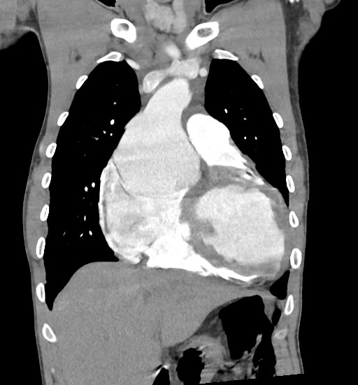 File:Aortic coarctation with aneurysm (Radiopaedia 74818-85828 C 37).jpg