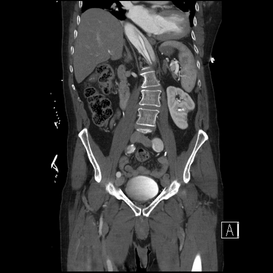 File:Aortic dissection (CTPA) (Radiopaedia 75506-86750 F 36).jpg