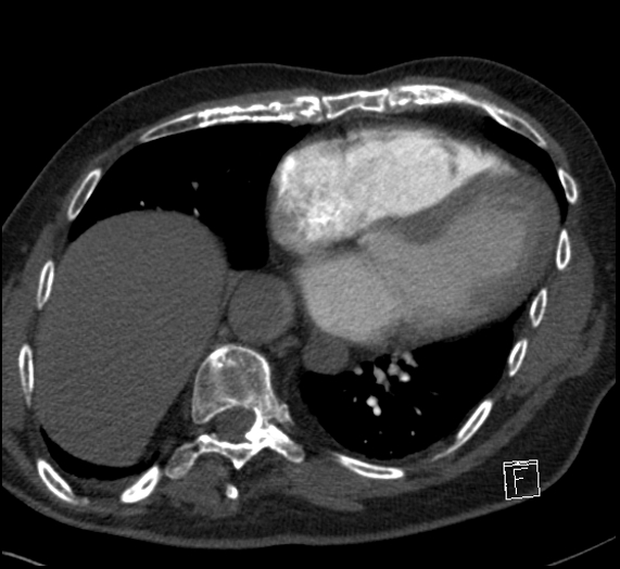 File:Aortic dissection (CTPA) (Radiopaedia 75506-86751 Axial C+ CTPA 94).jpg