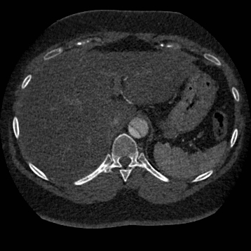 File:Aortic dissection (Radiopaedia 57969-64959 A 295).jpg