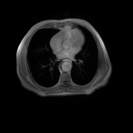 Aortic dissection - Stanford A - DeBakey I (Radiopaedia 23469-23551 Axial MRA 22).jpg