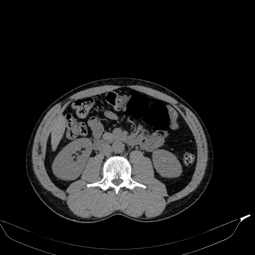 File:Aortic dissection - Stanford type A (Radiopaedia 83418-98500 Axial non-contrast 57).jpg
