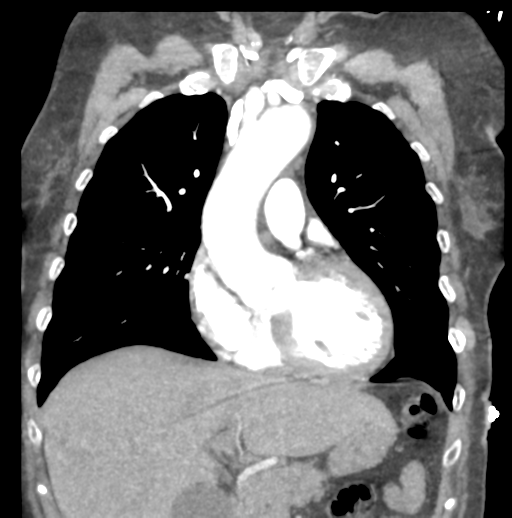 Aortic dissection - Stanford type B (Radiopaedia 50171-55512 B 31).png