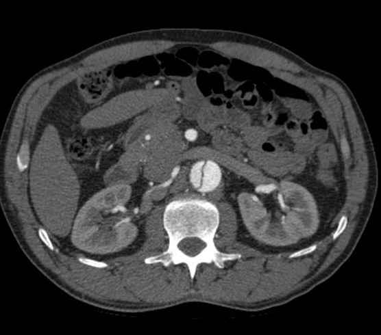 Aortic dissection - Stanford type B (Radiopaedia 73648-84437 A 143).jpg