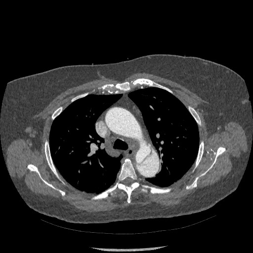 Aortic dissection - Stanford type B (Radiopaedia 88281-104910 A 23).jpg