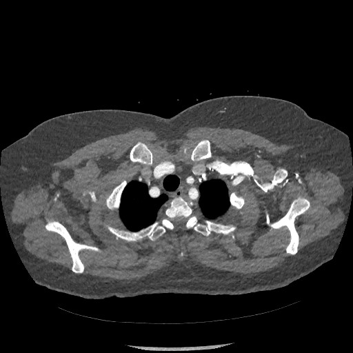 Aortic dissection - Stanford type B (Radiopaedia 88281-104910 A 6).jpg