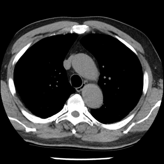 Aortic intramural hematoma (type B) (Radiopaedia 79323-92387 Axial non-contrast 15).jpg