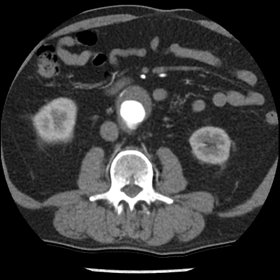 File:Aortic intramural hematoma (type B) (Radiopaedia 79323-92387 B 75).jpg