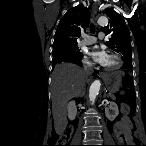 File:Aortic intramural hematoma from penetrating atherosclerotic ulcer (Radiopaedia 31137-31836 C 33).jpg