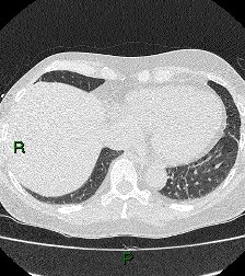 File:Aortic valve endocarditis (Radiopaedia 87209-103485 Axial lung window 77).jpg