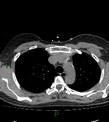 Aortic valve endocarditis (Radiopaedia 87209-103485 Axial non-contrast 29).jpg
