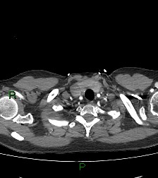 Aortic valve endocarditis (Radiopaedia 87209-103485 C 7).jpg