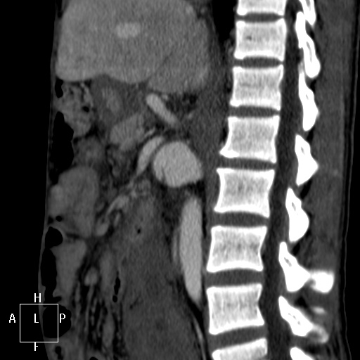 Aorto-left renal vein fistula (Radiopaedia 45534-49628 C 31).jpg