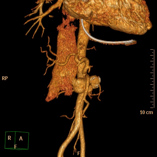 File:Aorto-left renal vein fistula (Radiopaedia 45534-49628 D 8).jpg