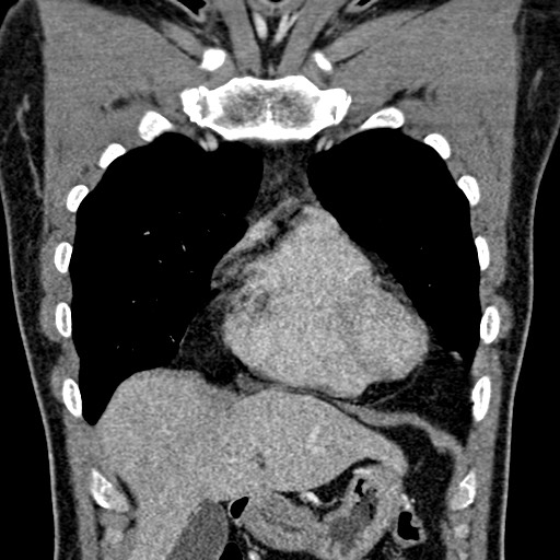 Apical lung mass mimic - neurogenic tumor (Radiopaedia 59918-67521 B 43).jpg