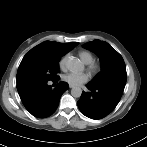 Apical pulmonary metastasis (Radiopaedia 46338-50754 B 37).png