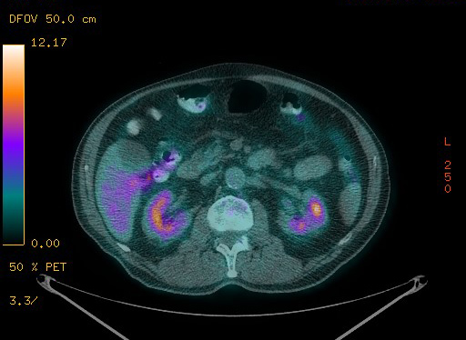 Appendiceal adenocarcinoma complicated by retroperitoneal abscess (Radiopaedia 58007-65041 Axial PET-CT 120).jpg
