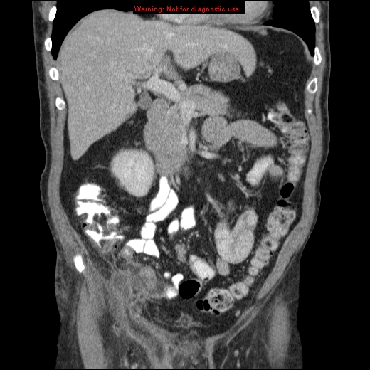 File:Appendicitis mass in inguinal hernia (Radiopaedia 26858-27029 B 26).jpg