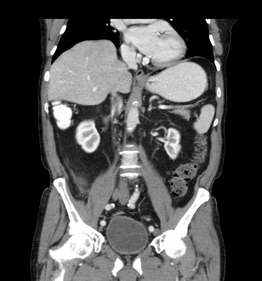 Appendicitis with localized perforation and abscess formation (Radiopaedia 49035-54130 B 26).jpg