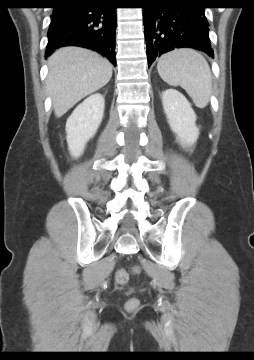 Appendicitis with thickening of the terminal ileum (Radiopaedia 42432-45550 B 44).png