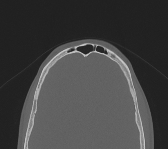 File:Arachnoid cyst - cerebellopontine angle (Radiopaedia 59689-67082 Axial bone window 42).png