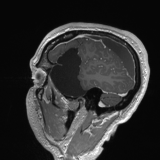 Arachnoid cyst with subdural hematoma (Radiopaedia 85892-101743 Sagittal T1 C+ 22).png
