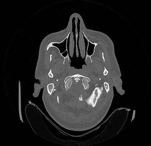 Arcuate foramen (Radiopaedia 89833-106944 Axial bone window 8).jpg