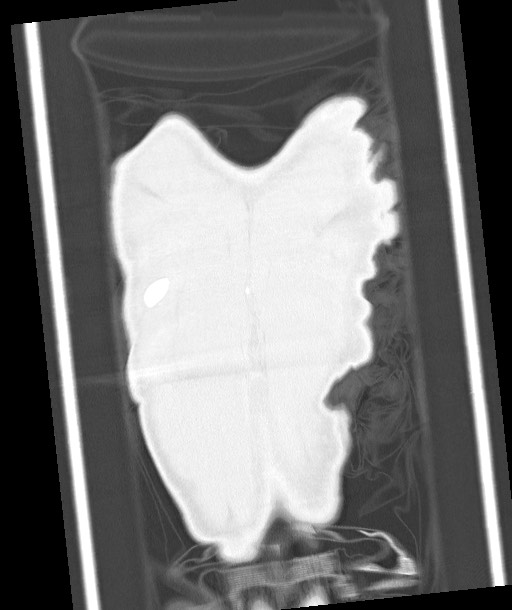 Arrow injury to the chest (Radiopaedia 85367-100975 Coronal lung window 123).jpg