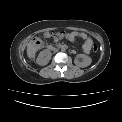 Ascending retrocecal appendicitis with liver abscesses (Radiopaedia 60066-67615 Axial non-contrast 38).jpg